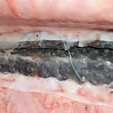 Bakteriell nyresykdom