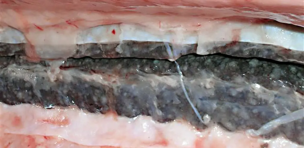 Bakteriell nyresykdom